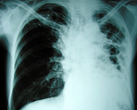 Болните от туберкулоза намаляват 