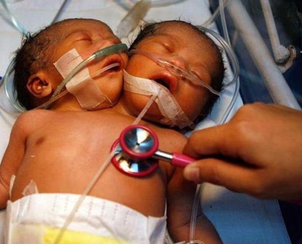Бебе с две глави се роди в Китай 