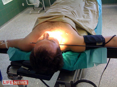 Хирурзи спасиха мъж пронизан от стрела в шията