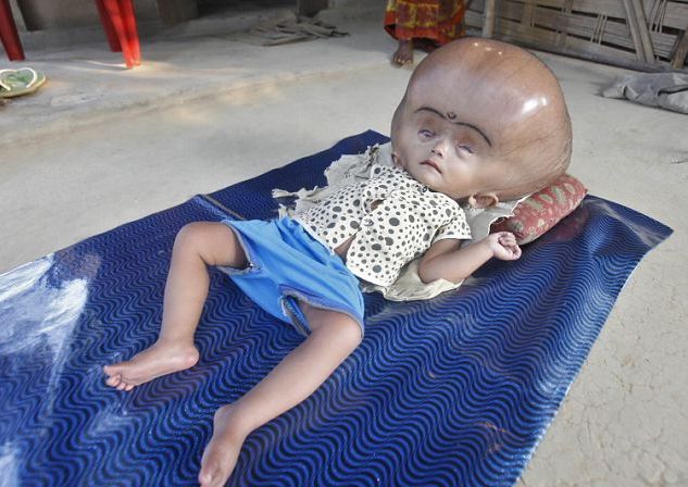 Страшна болест превърна главата на дете в балон