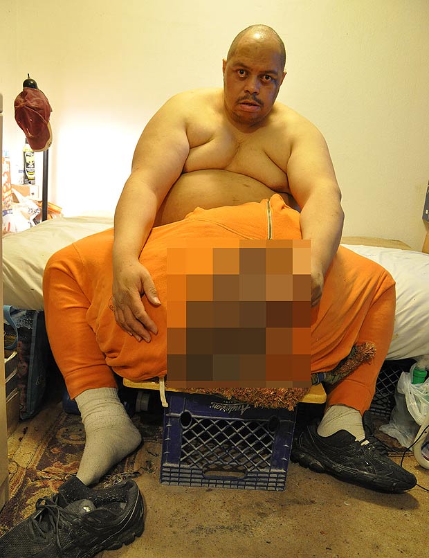 Мъжът с 45-килограмовия тестис след спасителната операция: Пенисът ми стана 2.5 сантиметра