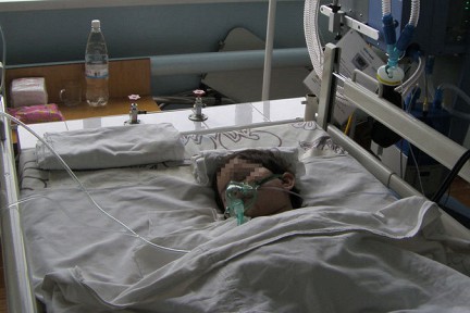 Дете с менингит прието в благоевградската болница