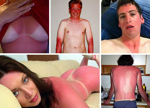 Вижте 12-те идиоти с най-малоумните слънчеви изгаряния (СНИМКИ)
