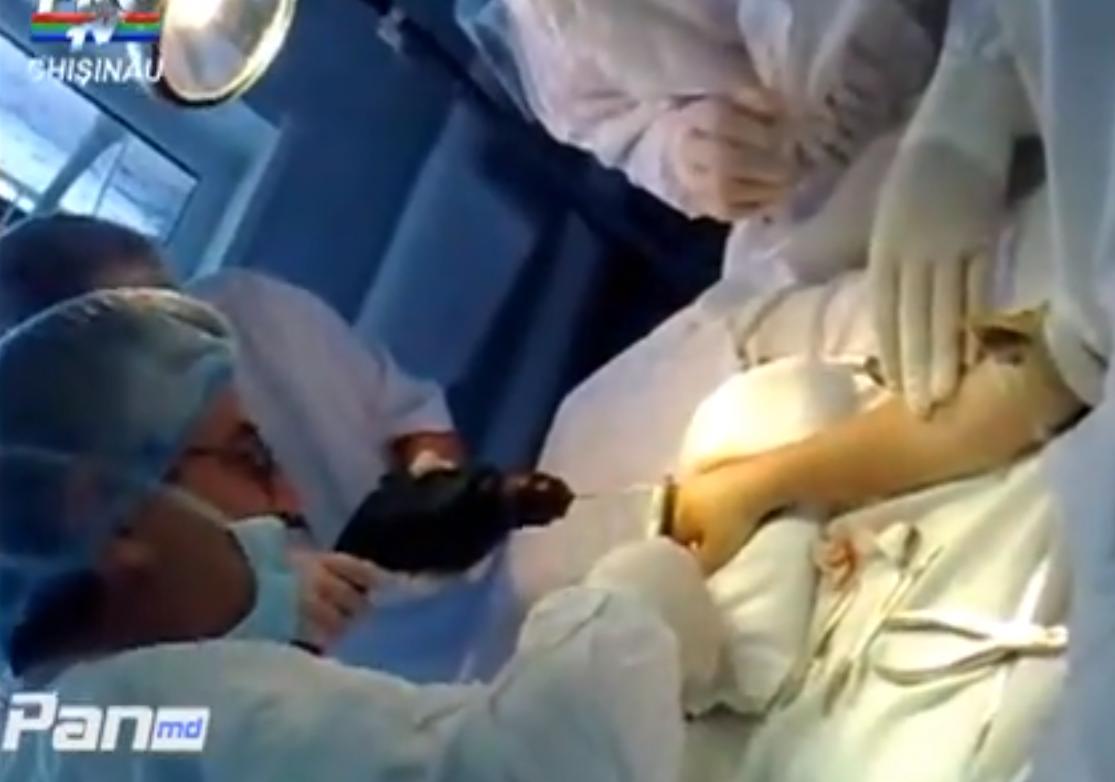 Вижте как оперират дете с дрелка и ръждиви клещи! (ВИДЕО 18+)