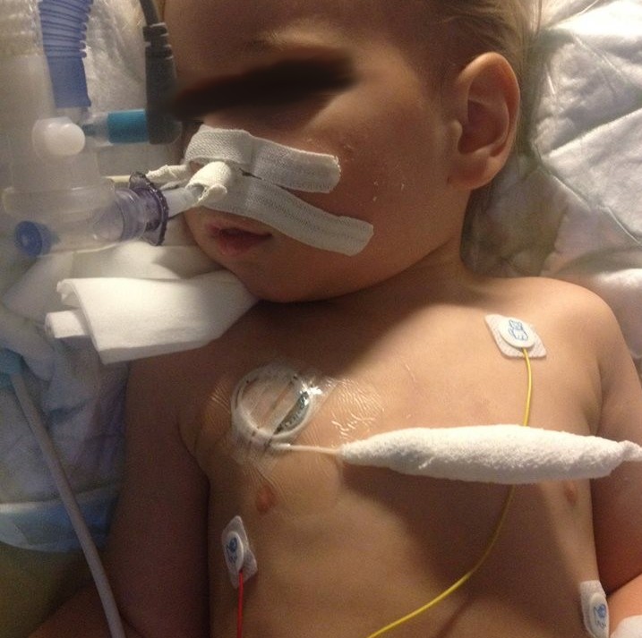 Момченце на 2 годинки вдиша ядки и изпадна в кома