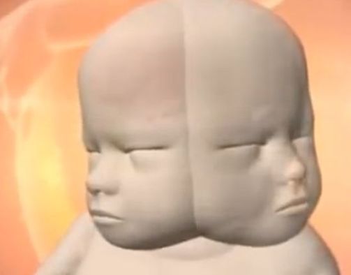 Бременна австралийка се готви да роди двуглаво бебе (ВИДЕО)