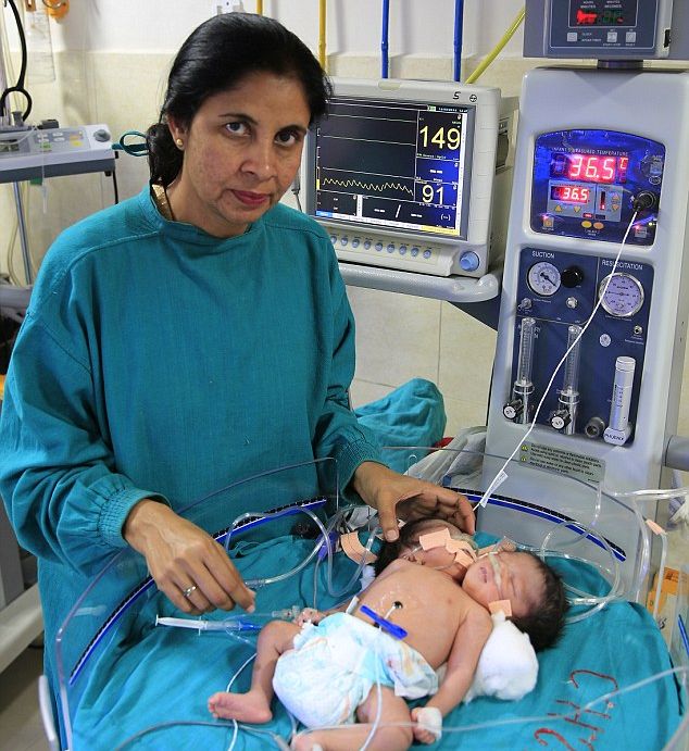Бебето с две глави почина 20 дни след раждането си (СНИМКИ/ВИДЕО)