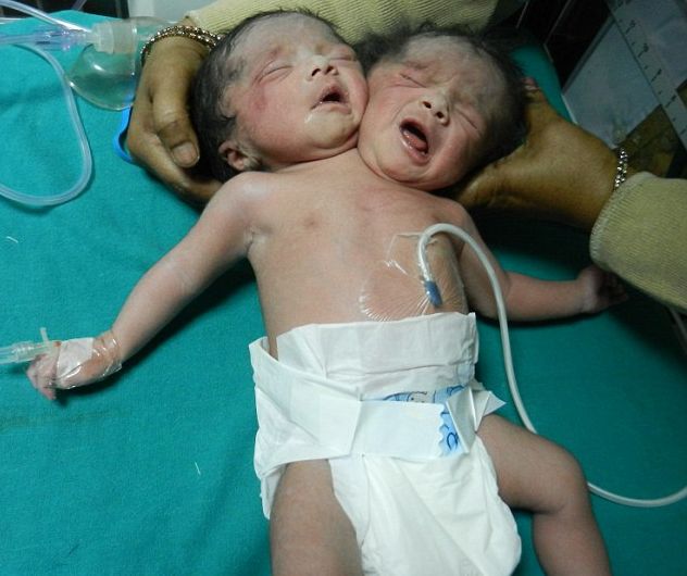 Бебето с две глави почина 20 дни след раждането си (СНИМКИ/ВИДЕО)