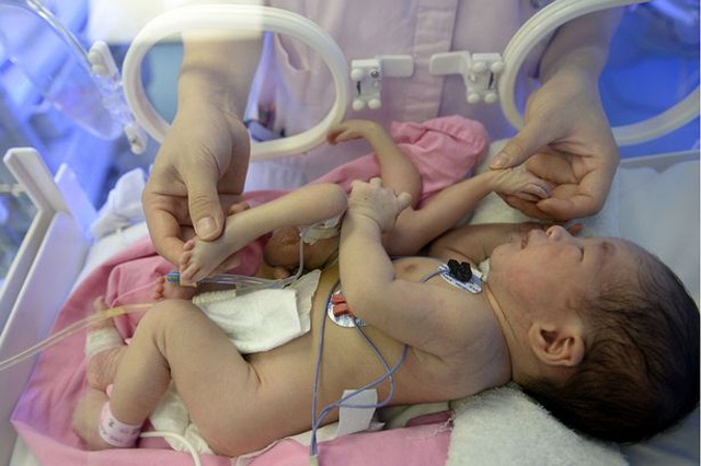 В Китай се роди бебе с 8 крайника