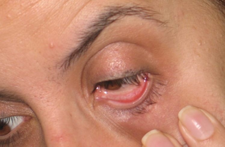 Опасен вирус атакува очите