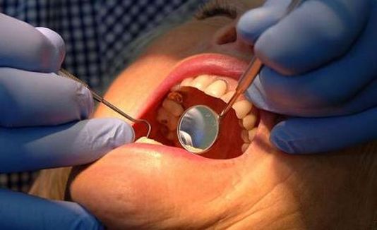 Пациентка съди зъболекар, глътнала инструмент