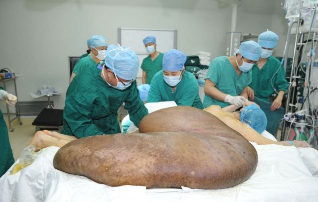 Лекари отстраниха най-големия тумор в света (СНИМКИ)