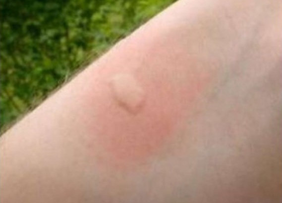 Моментално спиране на сърбеж от ухапване на комар