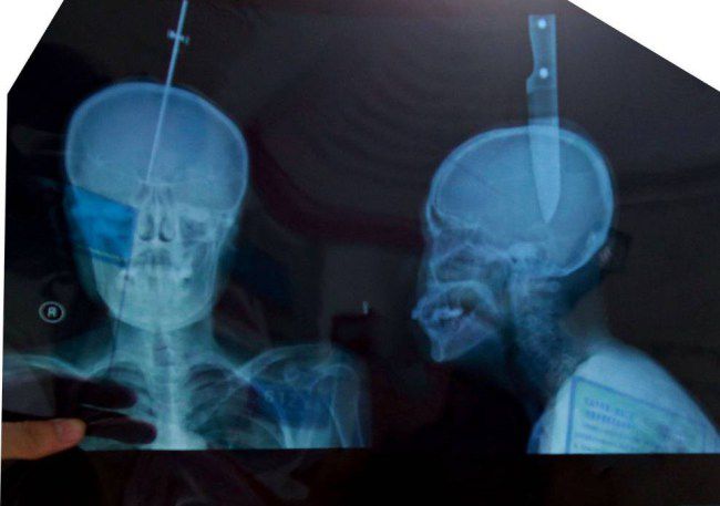 Жена с нож в главата влезе в болницата на собствен ход