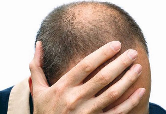Лекарство възстановява растежа на коса при един вид оплешивяване