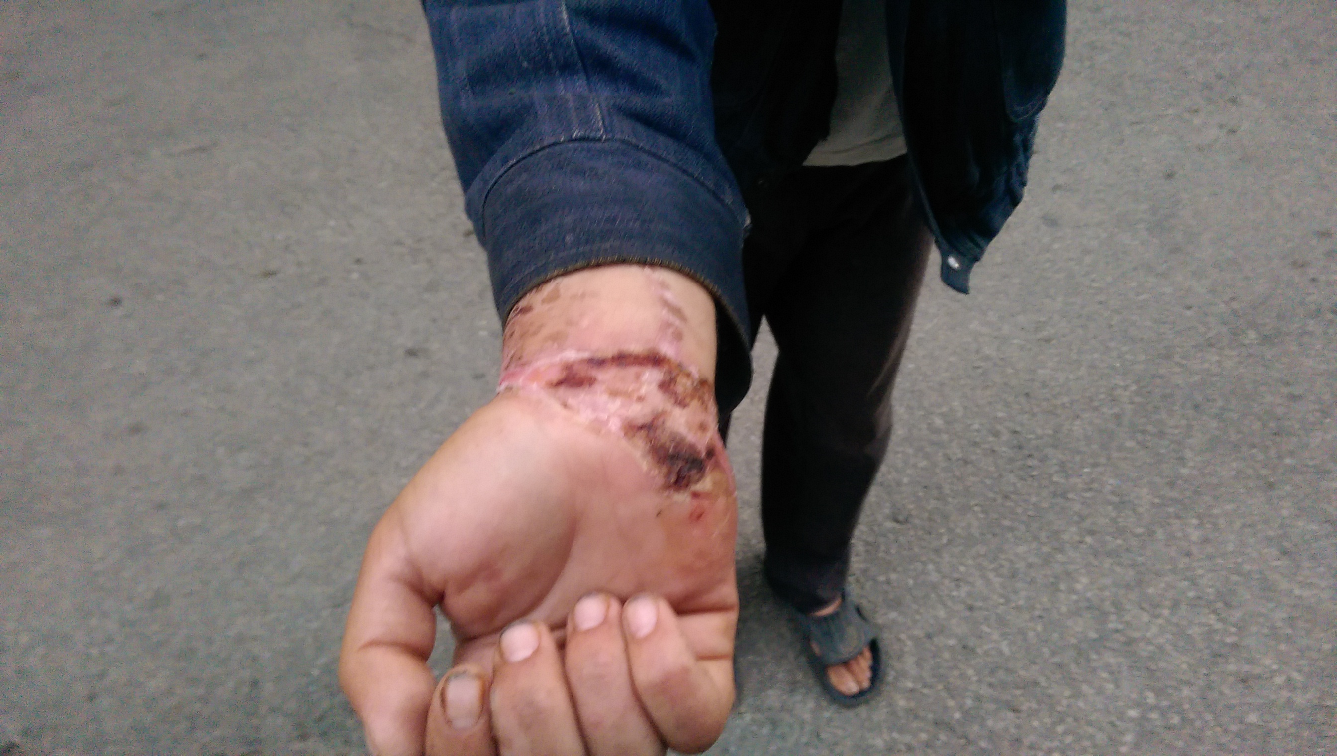 Лекари смазали ръцете на &quot;хахо&quot; от Берковица с бинтове, докато буйствал