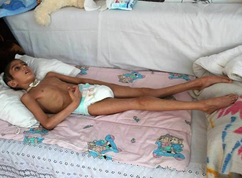 Недохранено дете е в будна кома, баща му почина днес - да помогнем!