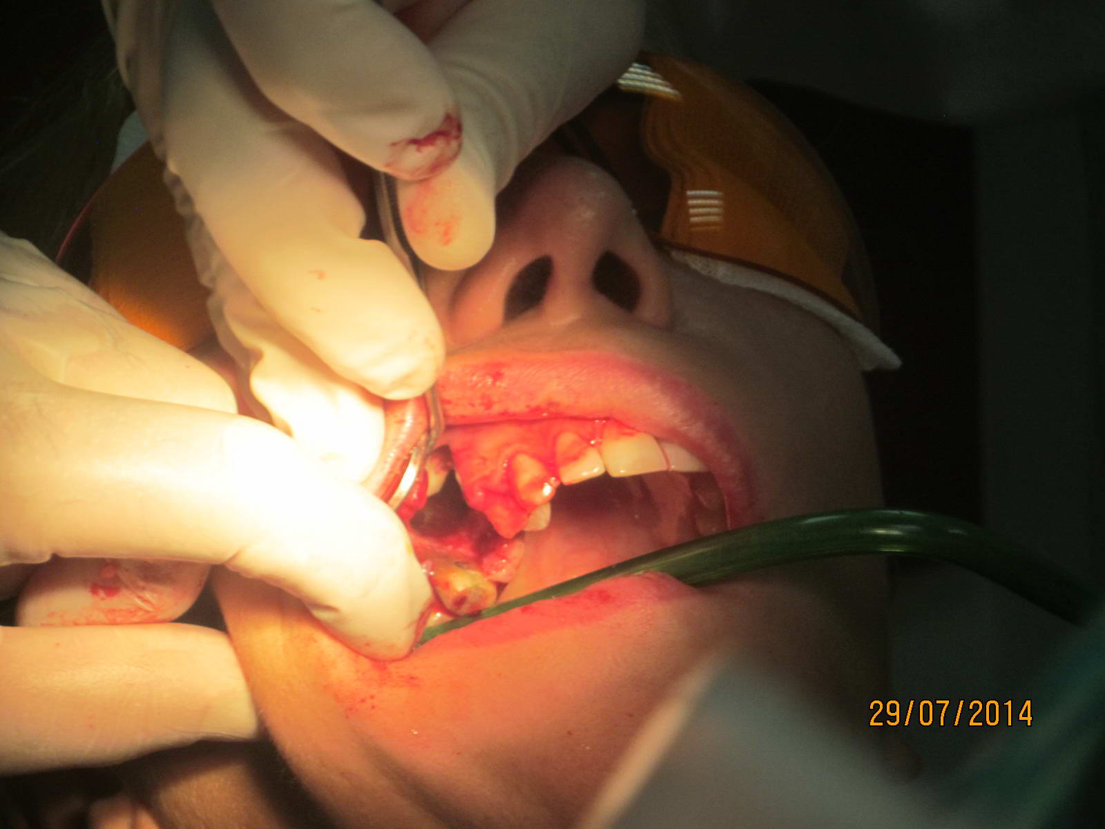 Обезобразената при стоматолог Росица: Баща ми се разплака, грабна пушката да го гърми!