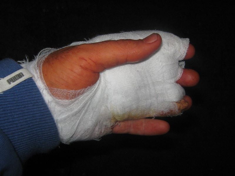 Първо в БЛИЦ: Жена с отрязани пръсти след злополука