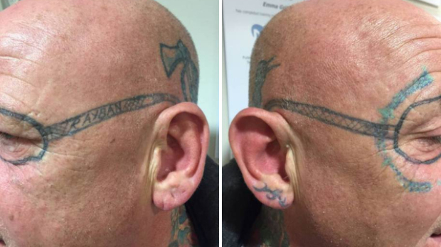 Мъж се събудил с татуирани очила след пиянско ергенско парти (СНИМКИ/ВИДЕО)