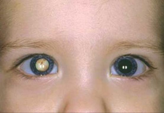 Научен пробив! Присадени стволови клетки върнаха зрението на деца с катаракта