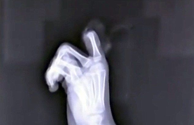 Баща се скара на сина си за игра със смартфон, детето си отряза пръста в знак на протест (СНИМКИ)