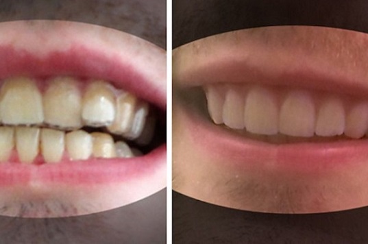 Стоматологията в шок: Студент сам си оправи кривите зъби и спести хиляди долари от брекети (СНИМКИ)