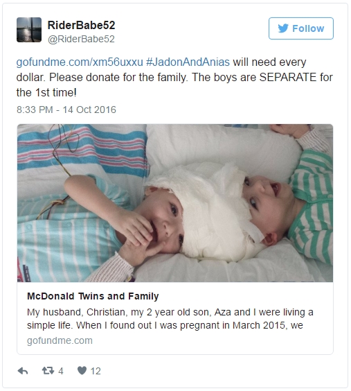 Чудото е факт! Разделиха сиамски близнаци на 13 месеца в Ню Йорк (СНИМКИ)