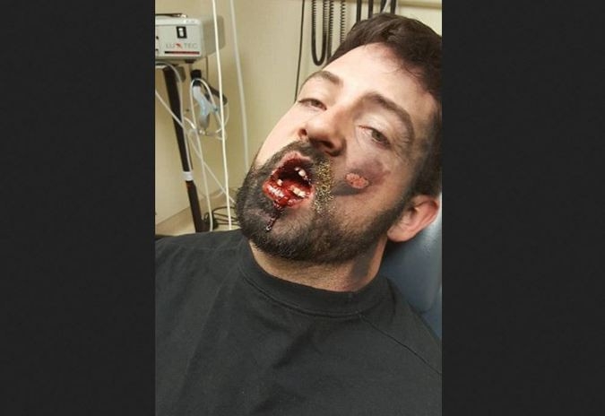 Електронна цигара се взриви в устата на мъж, изби му седем зъба (СНИМКИ 18+)