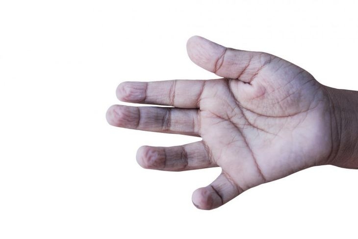 Вижте как може да се разпознае карцином по пръстите на ръцете