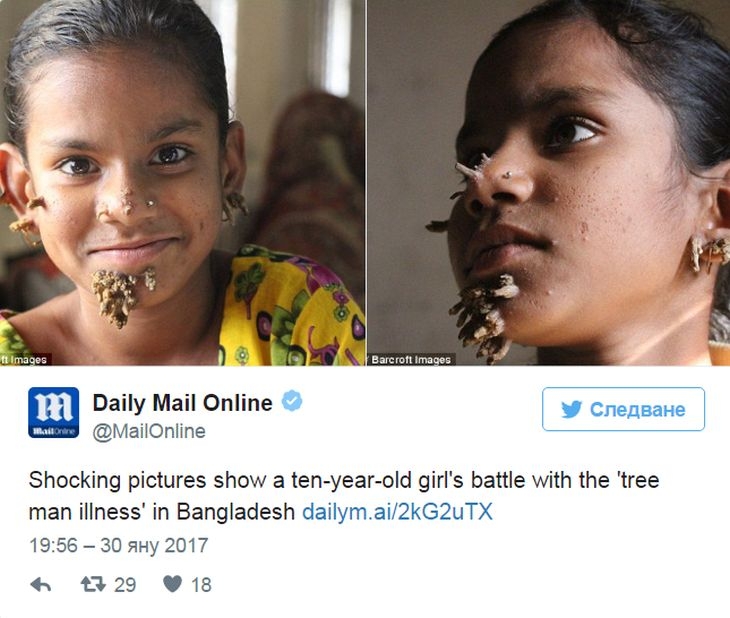 За първи път в света! 10-годишно момиче вероятно се превръща в... дърво (УНИКАЛНИ СНИМКИ/ВИДЕО)
