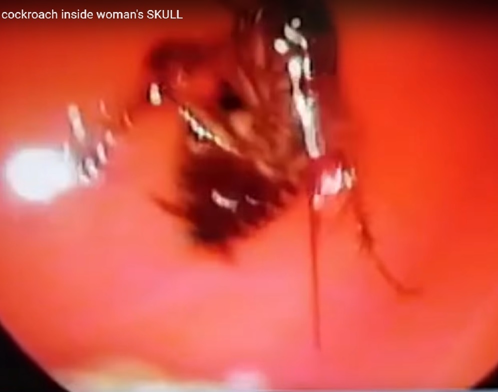Хлебарка се вмъкна в носа на жена и заседна между очите й (ВИДЕО)
