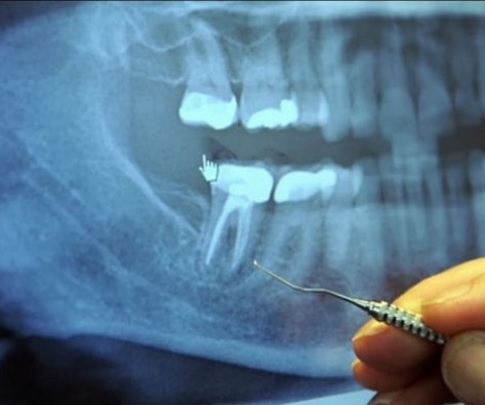 Излезе наяве шокираща статистика, която зъболекарите крият или просто не знаят: 97% от хората с рак и други сериозни заболявания, са имали тази процедура на зъбите