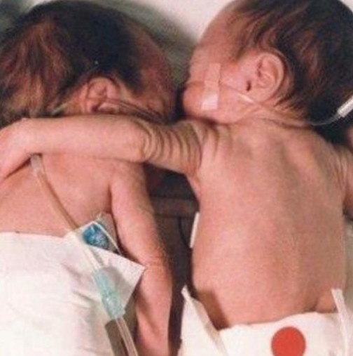 Невероятно чудо преди 18 години! Тази прегръдка завинаги промени медицината! Ето как изглеждат тези близначки днес! (ВИДЕО)
