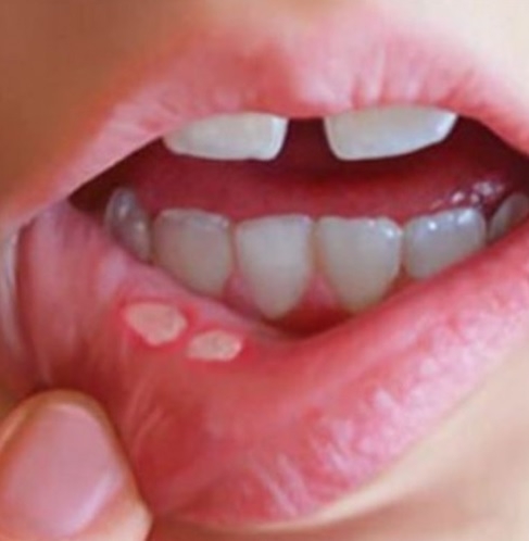 Имате ли рани в устата? Ето на какви сериозни заболявания са симптом афтите 