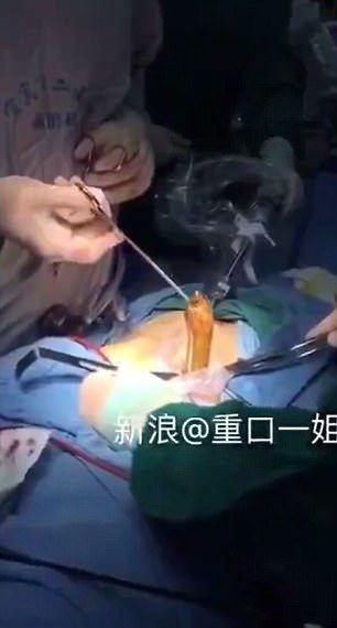 Ужасяващ момент: Лекари вадят змиорка от тялото на пациент „след нестандартен секс” (ВИДЕО 18+)