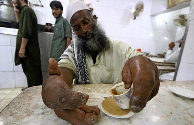 Възрастен пакистанец, страдащ от тежка аномалия, проси на улицата, за да нахрани трите си деца (СНИМКИ)