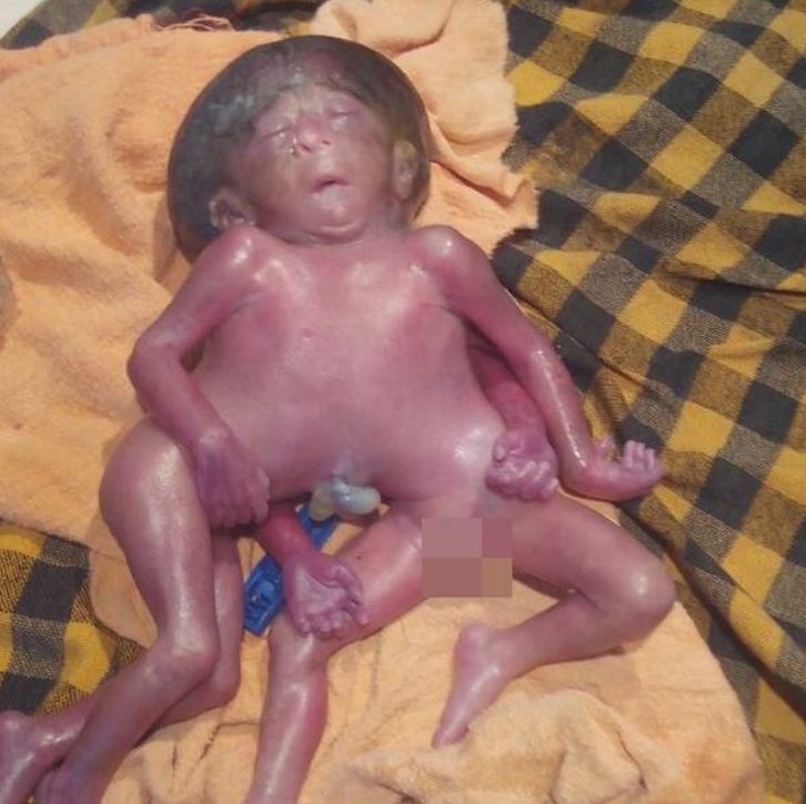 Новородено с четири ръце и четири крака шокира лекарите (СНИМКИ/ВИДЕО 18+)