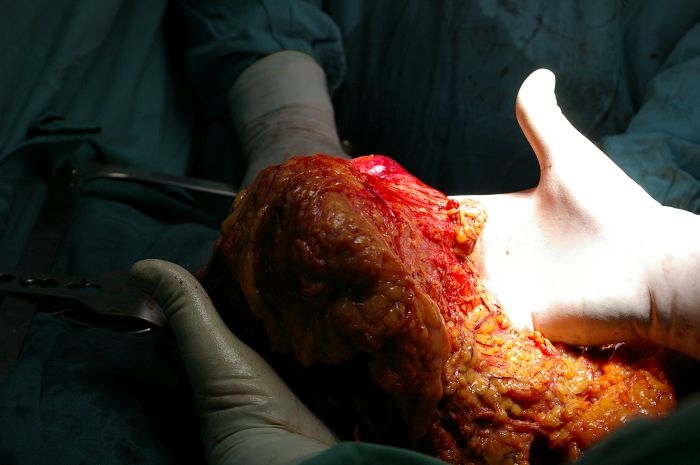 Водещи хирурзи от "Пирогов" извадиха 2-килограмов тумор от дебелото черво на пациент (СНИМКИ 18+)