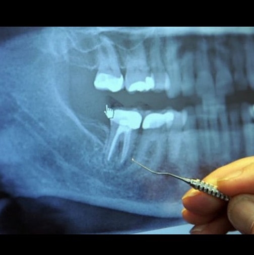 Нови шокиращи резултати: 97% от хората с рак са имали тази процедура на зъбите