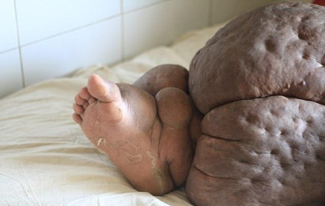 Паразити превърнаха крака на тази жена в 60-килограмово чудовище (СНИМКИ)