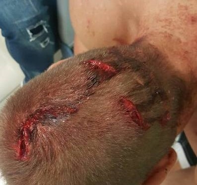 Пак безчинство! Шокиращи кадри с раните по главата на пребития от роми българин в село Мъглен (СНИМКИ 18+)
