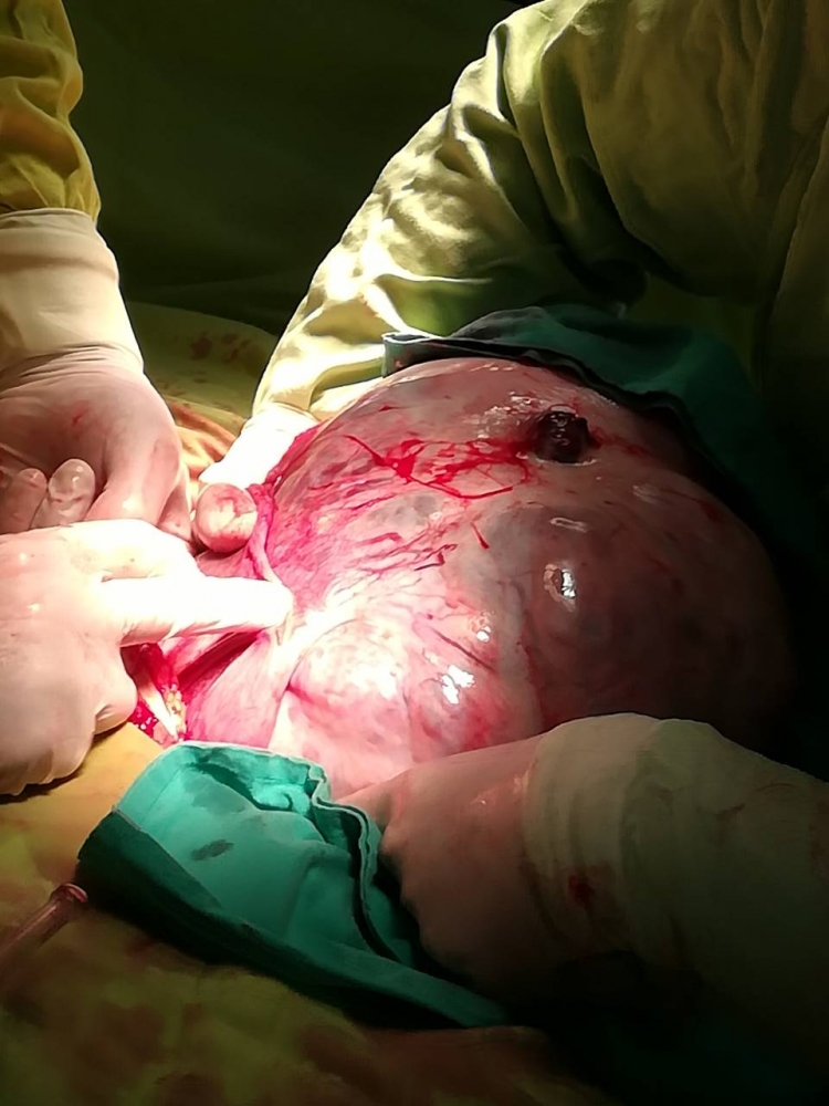 Изумителна операция в "Пирогов"! Извадиха 5-килограмов тумор от момиченце (СНИМКИ)