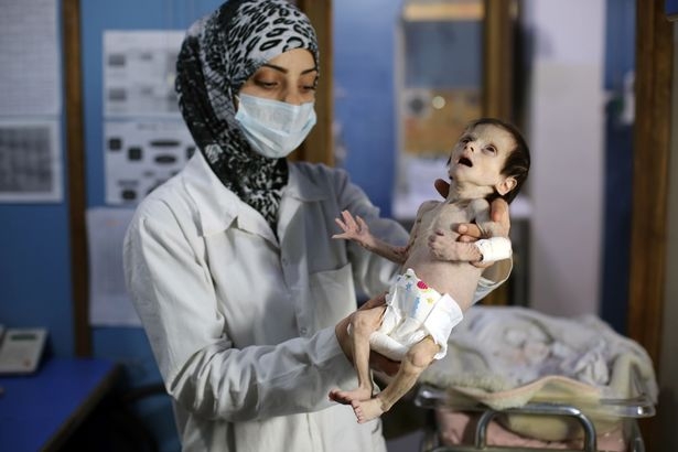 Лицето на войната: Ужасяващи СНИМКИ (18+) на недохранено сирийско момченце шокираха света 