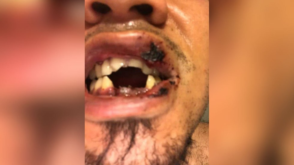 Шокиращо: Мъж загуби 4 зъба след експлозия на електронна цигара (СНИМКА 18+)
