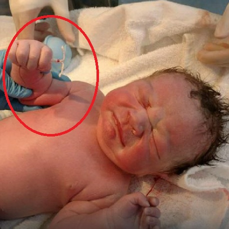 Чудо! Бебе се роди, стискайки в ръчичка онова, което трябваше да го убие още при зачеването (СНИМКИ)