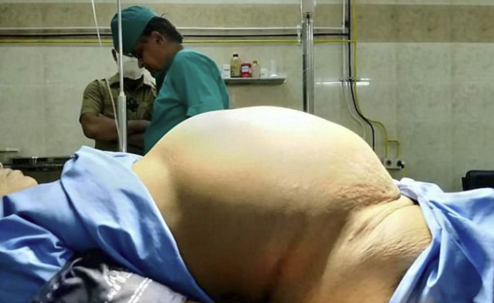 Отстраниха близо 12-килограмов тумор от яйчника на "бременна" пенсионерка (СНИМКИ 18+)