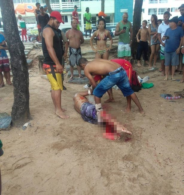 Кръвожадна акула нападна турист, наложи се да му ампутират крака (СНИМКИ/ВИДЕО 18+)