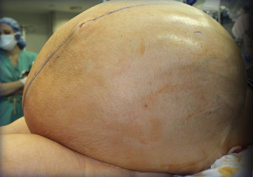 Извадиха 60-килограмов тумор от яйчника на американка (ВИДЕО)