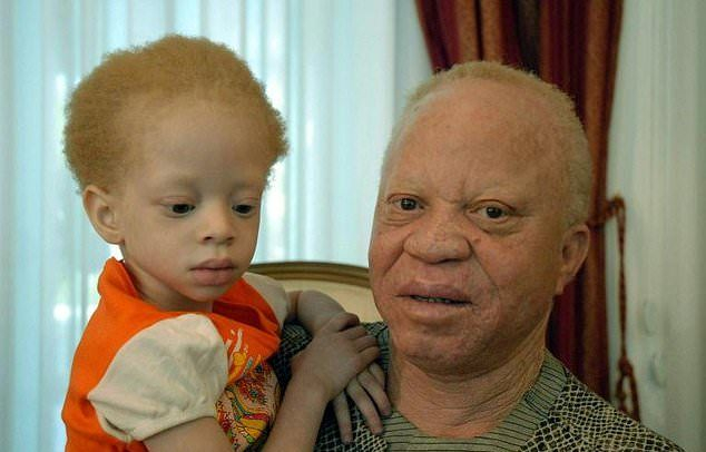 Момиче албинос беше отвлечено пред очите на майка си заради ритуал и след това обезглавено